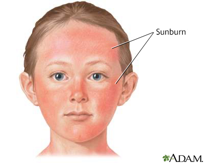 Sunburn Sunburn