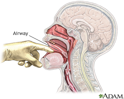 Check airway Check airway