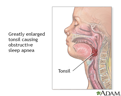 Obstructive sleep apnea Obstructive sleep apnea