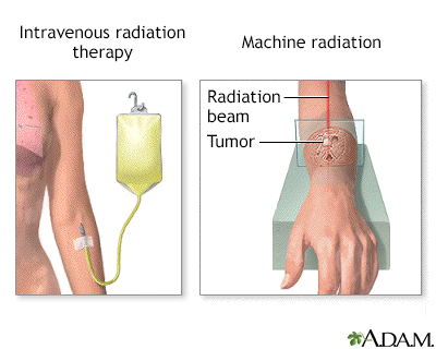 Radiation therapy Radiation therapy