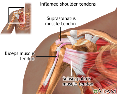 Inflamed shoulder tendons Inflamed shoulder tendons