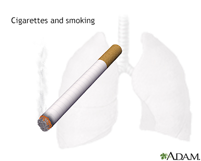 Smoking hazards Smoking hazards