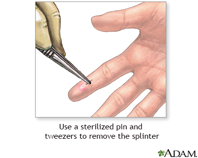 Splinter removal Splinter removal