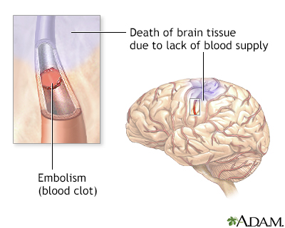 Stroke Stroke