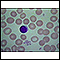 Thumbnail image of healthy red blood cells.